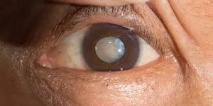 Premium IOL Options for Cataract Surgery at Gandhi Eye Centre Faridabad