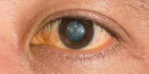 Toric IOL for Astigmatism & Cataract at Gandhi Eye Centre Faridabad