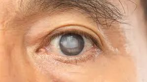 ICL Surgery (Phakic Lens Implant) at Gandhi Eye Centre Faridabad