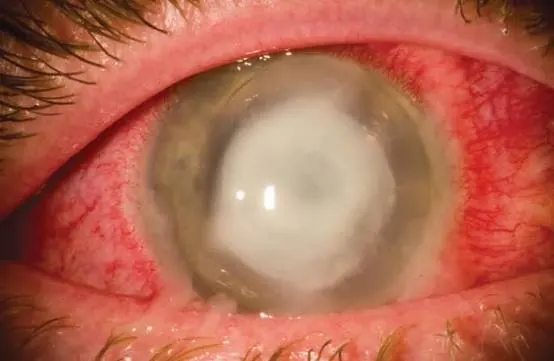 Dry Eye Diagnosis & Treatment at Gandhi Eye Centre Faridabad